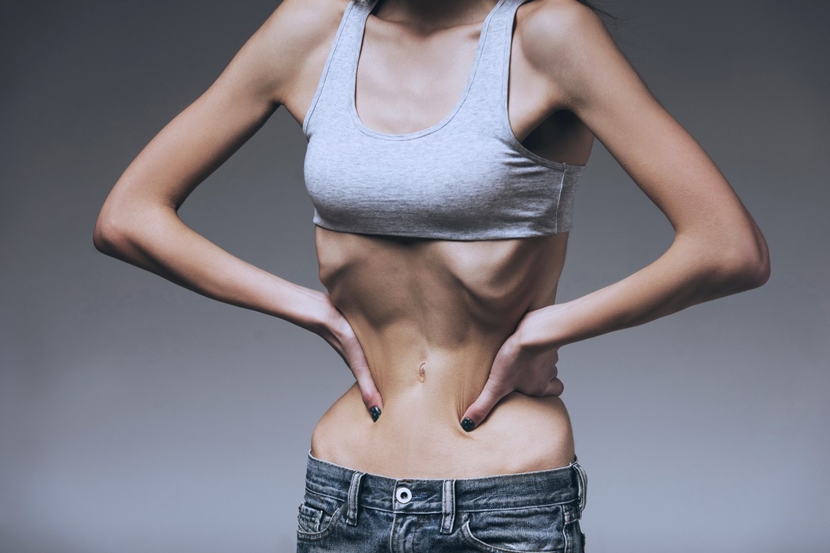 Anoreksiya Nedir?